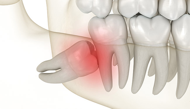 Tooth Extractions in Northridge